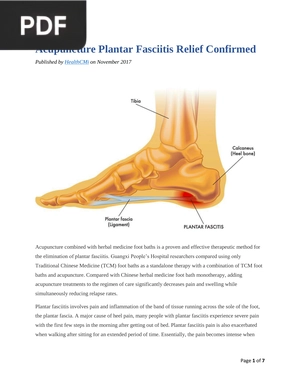 Acupuncture Plantar Fasciitis Relief Confirmed