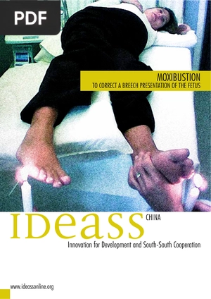 Moxibustion to correct a breech presentation of the fetus